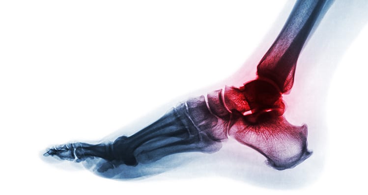 Click here to learn how we treat foot arthritis
