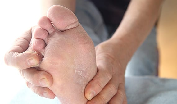 Male checking for athlete's foot.