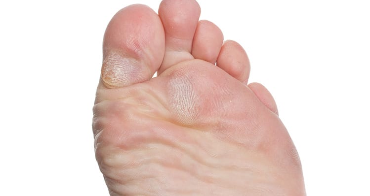 Click here to learn how we treat corns & calluses