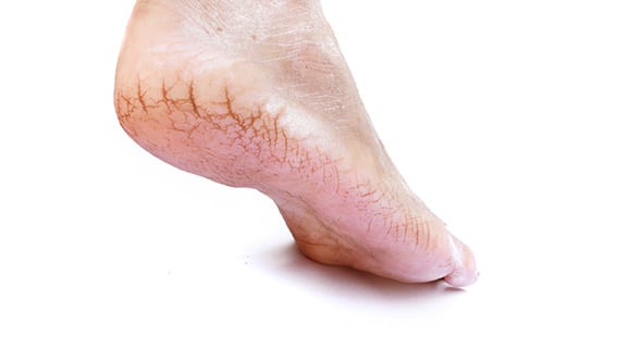 Foot with fissures at the bottom of the heel.