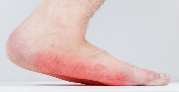 Foot with fallen arches resulting in flat foot.