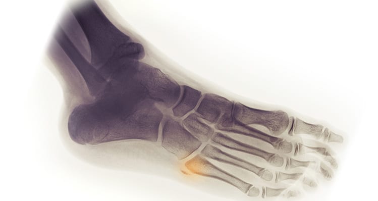 Click here to learn how we treat fractures