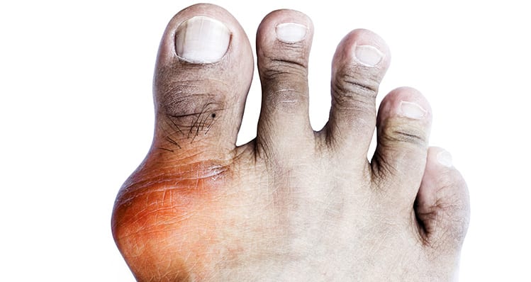 Click here to learn how we treat gout