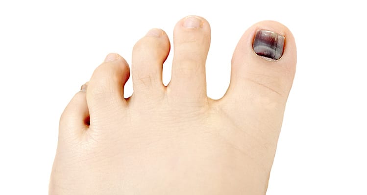 Click here to learn how we treat hammertoe