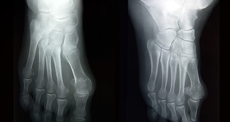 Click here to learn how we treat Lisfranc joint injury