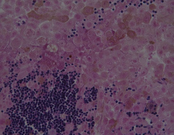 Melanoma underneath a microscope.