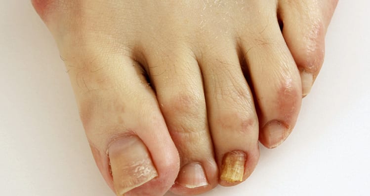 Click here to lean how we treat nail problems