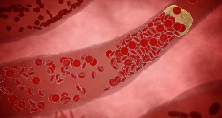 Click here to learn how we treat peripheral artery disease