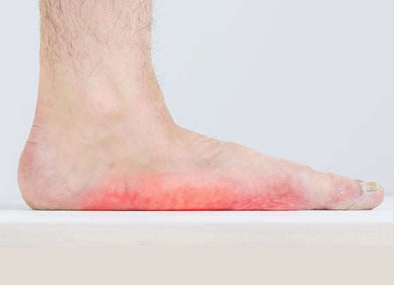 Foot suffering with posterior tibial tendon dysfunction.