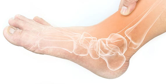 Skeletal anatomy of foot with ankle tendonitis.