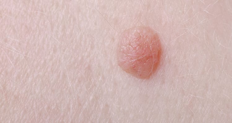 Click here to learn how we treat warts