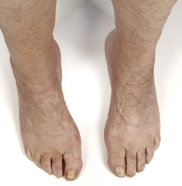 A pair of older feet with arthritis.