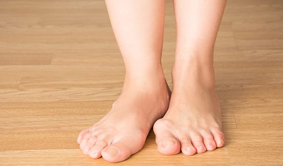 Woman's feet suffering with bunion discomfort.