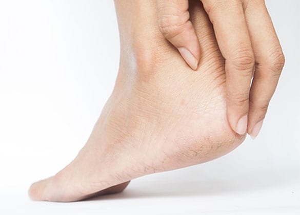 Woman holding foot because of pain from fissures.