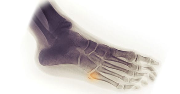 An x-ray of foot with fracture at pinky toe.