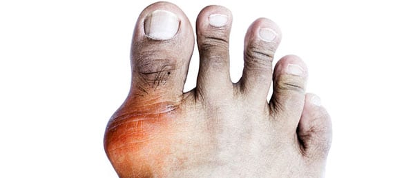 Male foot suffering from painful gout.