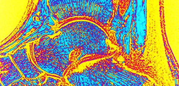 Haglund's deformity through a microscope.