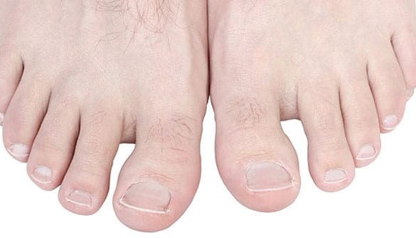 A pair of feet dealing with hallux rigidus.