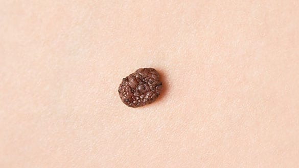 Melanoma of the foot.
