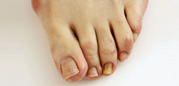 Foot with toenail problems.