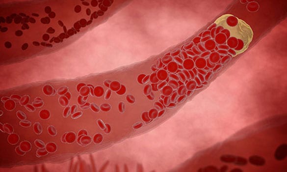 Buildup of of plaque in the arteries that leads to peripheral artery disease.