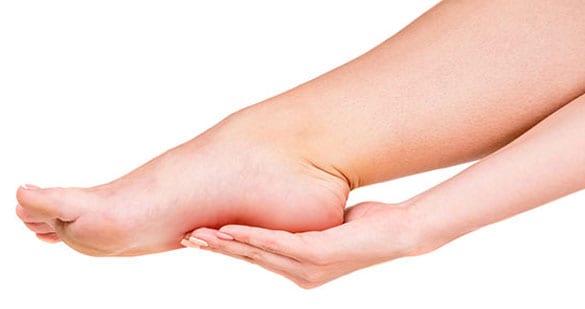 Foot with pain in the arch area because of plantar fibroma.
