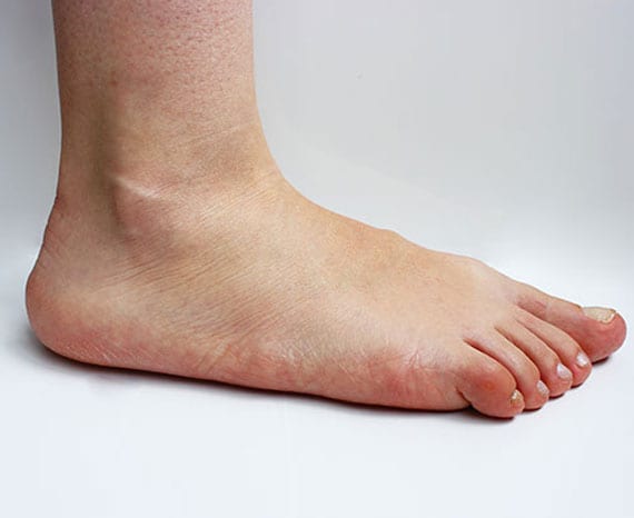 Foot with posterior tibial tendon dysfunction.