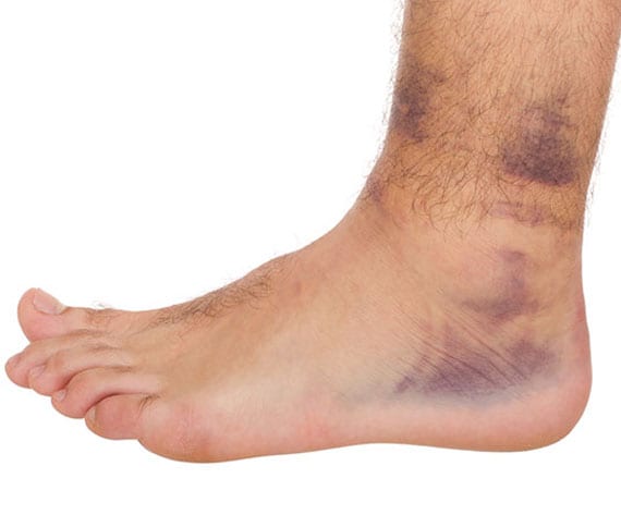 Foot bruised from sprain.