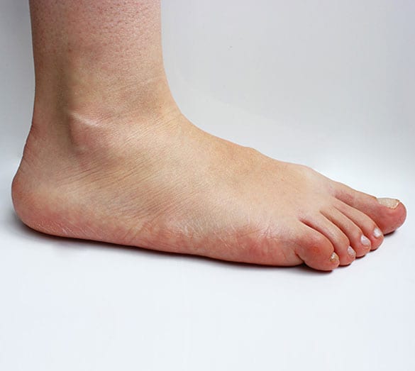 Foot in need of surgical flat foot correction.
