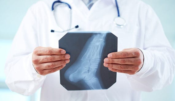 Physician holding an x-ray of foot in need of TOPAZ treatment.