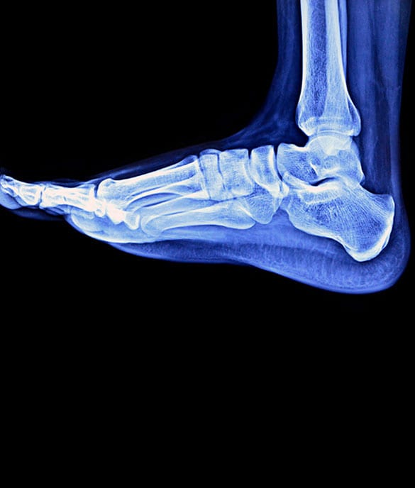 X-ray of foot with tarsal coalition.