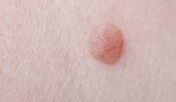 A plantar wart.