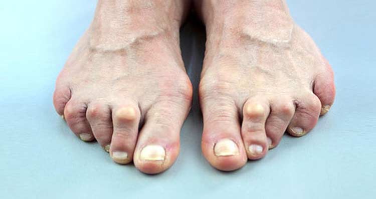A pair of feet suffering with arthritis pain.