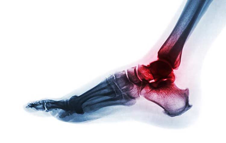 X-ray of foot with ankle joint arthritis.