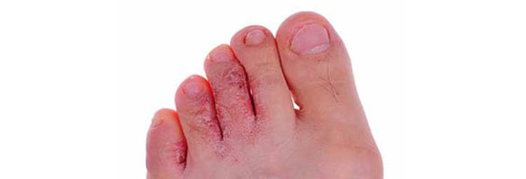 Fungal infection on the skin of the foot called athlete's foot.