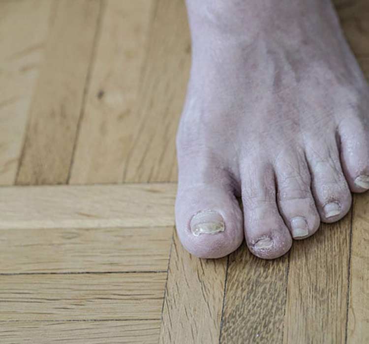 Older foot with fungal infection called athlete's foot.