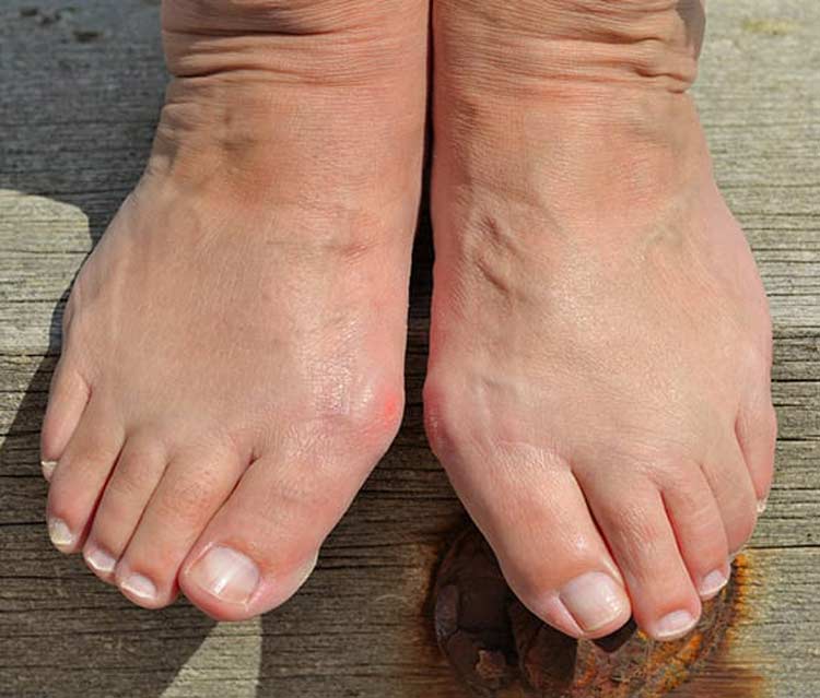 Feet suffering with bunion discomfort.