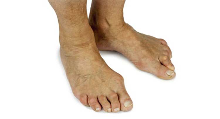 Feet with structural abnormality due to bunions.