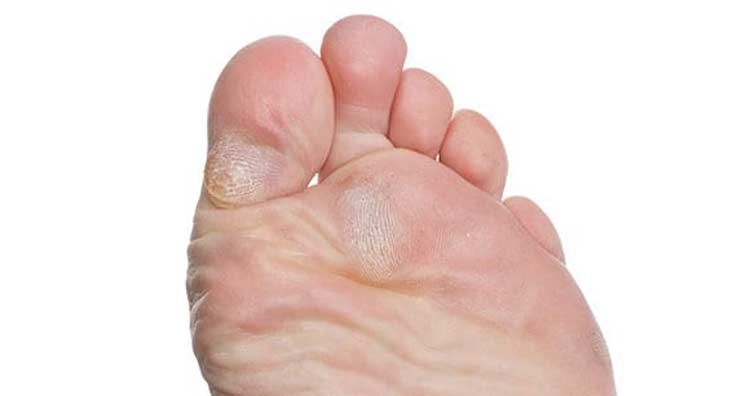 Foot with uncomfortable corn & callus condition.