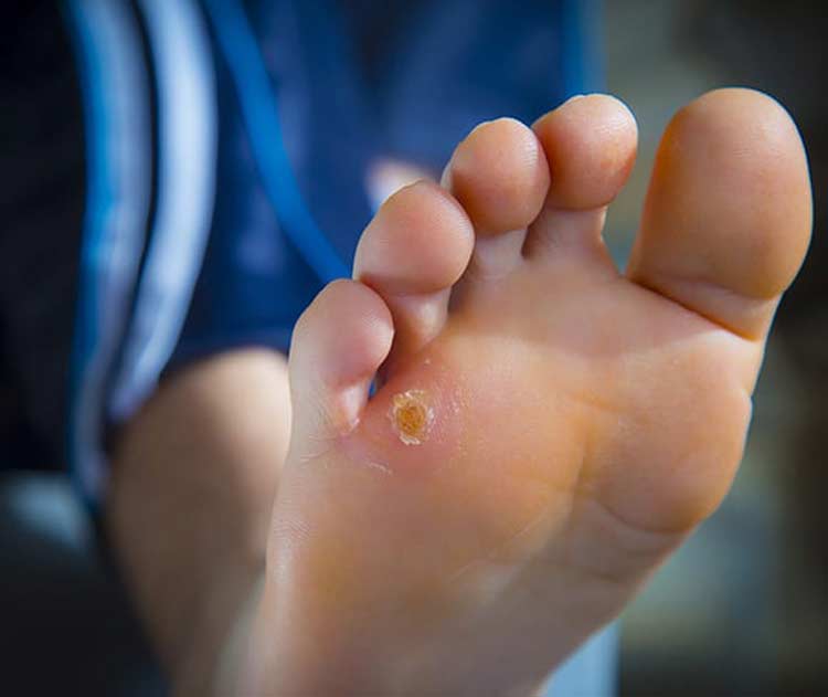 Foot with corn & callus condition.