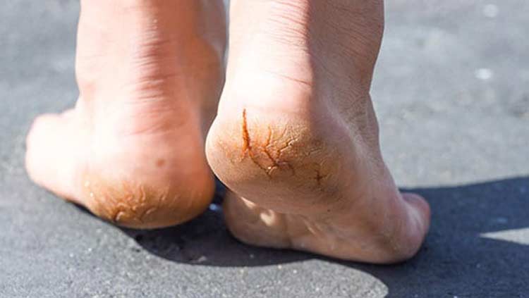 Feet suffering with painful fissures at the bottom of the heel.