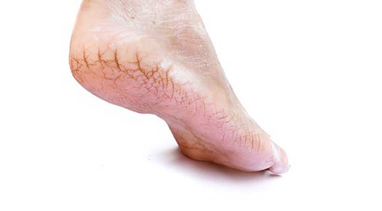 Foot with fissures at the bottom of the heel.