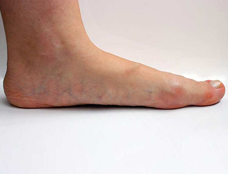 Foot with natural arch collapse resulting in flat foot.