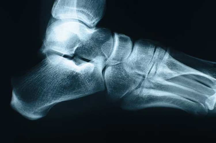 An x-ray of foot with ankle fracture.