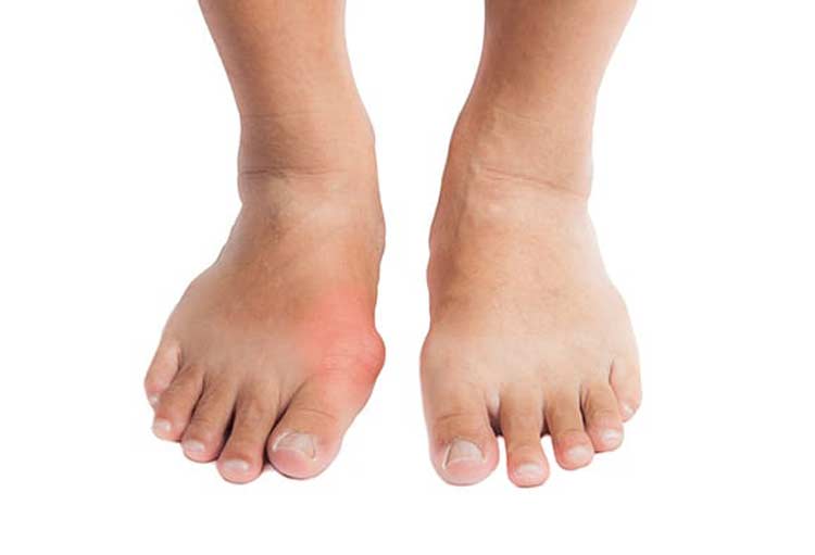 Pair of feet with gout foot condition.
