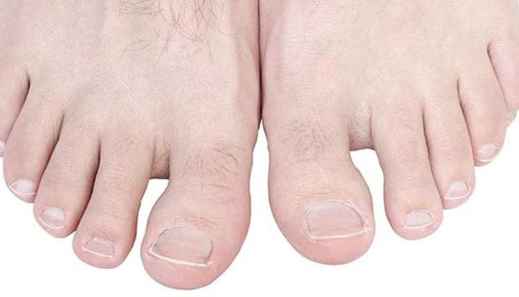 A pair of feet dealing with hallux rigidus.