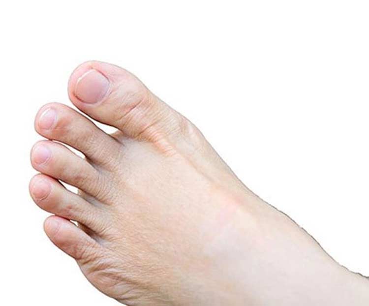 Foot with hallux rigidus.