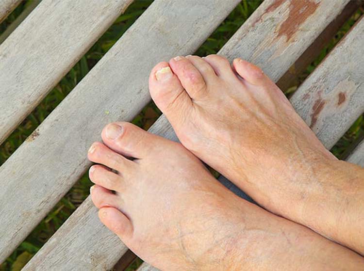 Pair of feet with hammertoe condition on left foot.