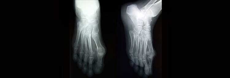 X-ray of a pair of feet dealing with Lisfranc joint injury.