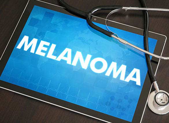 Melanoma on a tablet with a stethoscope.